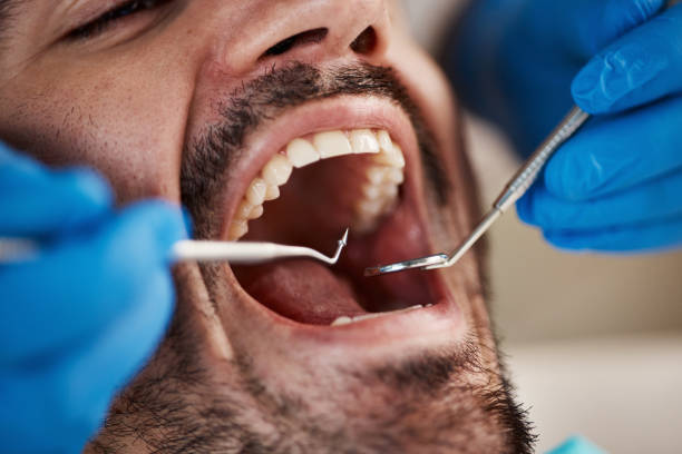 Best Emergency Treatment for Dental Infections or Abscesses in Huntington Park, CA